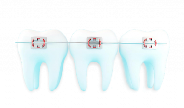 Aparelho Dentário é no Plano Sorrir