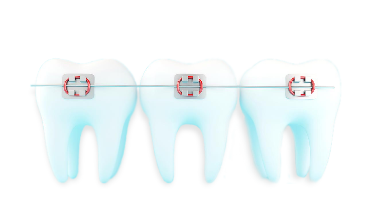 Aparelho Dentário é no Plano Sorrir